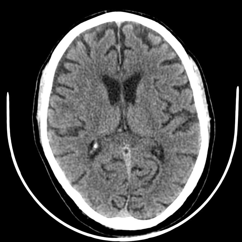 Brain metastasis (Radiopaedia 42617-45760 Axial non-contrast 25).jpg