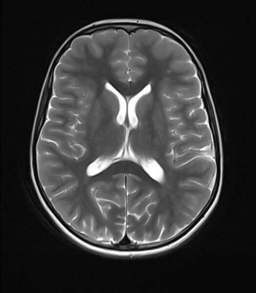 File:Brainstem glioma (Radiopaedia 70548-80674 Axial T2 15).jpg