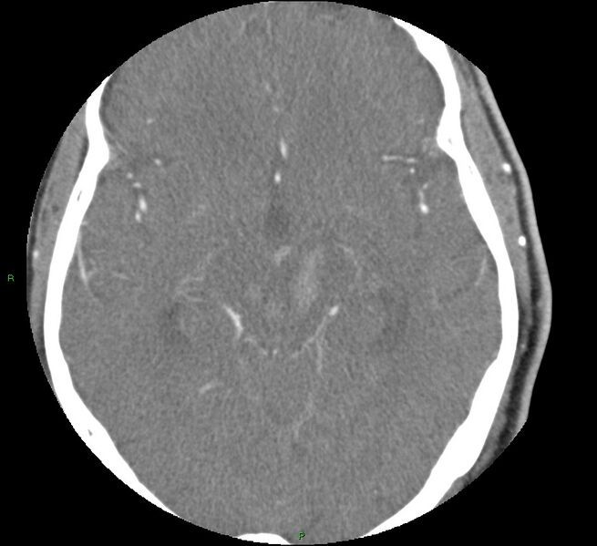 File:Brainstem hemorrhage (Radiopaedia 58794-66028 D 86).jpg