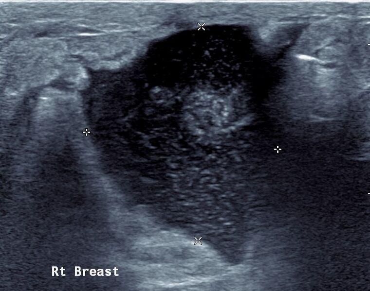 File:Breast abscess (Radiopaedia 55347-61769 B 1).jpg