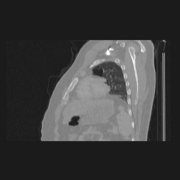 File:Bronchial atresia (Radiopaedia 60685-68439 Sagittal lung window 73).jpg