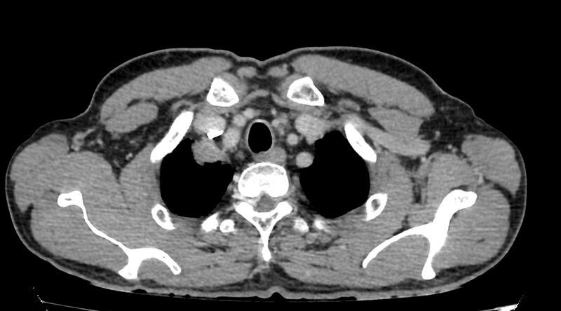 File:Bronchogenic carcinoma with superior vena cava syndrome (Radiopaedia 36497-38054 Axial C+ delayed 5).jpg