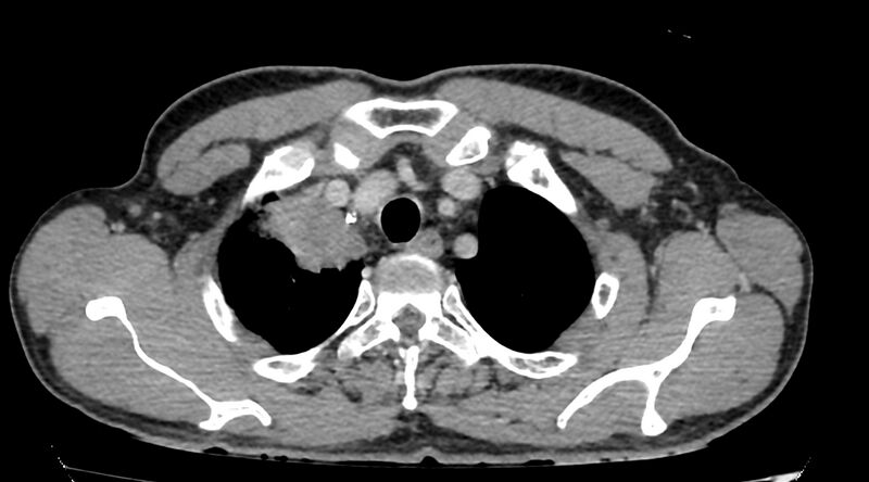 File:Bronchogenic carcinoma with superior vena cava syndrome (Radiopaedia 36497-38054 Axial C+ delayed 9).jpg