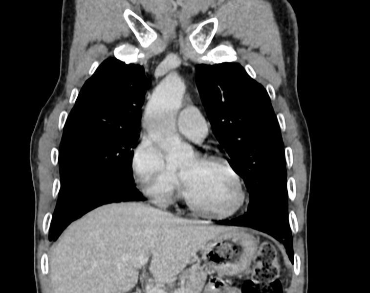 File:Bronchogenic carcinoma with superior vena cava syndrome (Radiopaedia 36497-38054 Coronal C+ delayed 3).jpg
