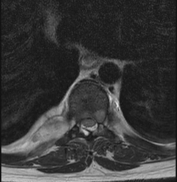 File:Brown tumors compressing the spinal cord (Radiopaedia 68442-78030 A 22).jpg