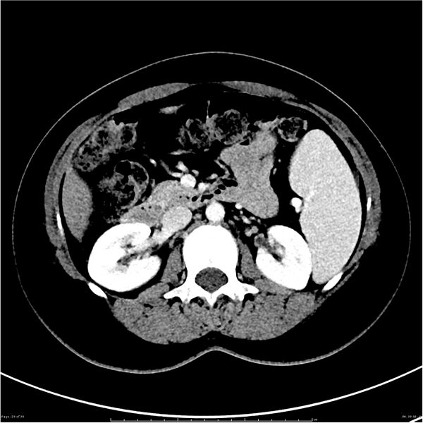 File:Budd-Chiari syndrome (Radiopaedia 27929-28177 Axial liver window 29).JPG