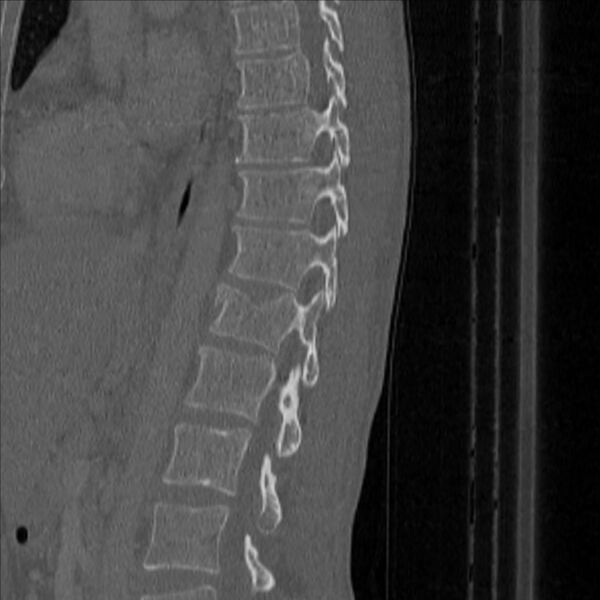 File:Bulging of paraspinal line in traumatic thoracal spinal compression fracture (Radiopaedia 29221-35872 Sagittal bone window 34).jpg