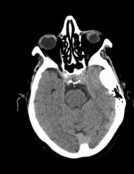 File:Burnt-out meningioma (Radiopaedia 51557-57337 Axial non-contrast 13).jpg