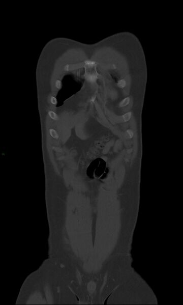 File:Burst fracture (Radiopaedia 83168-97542 Coronal bone window 14).jpg