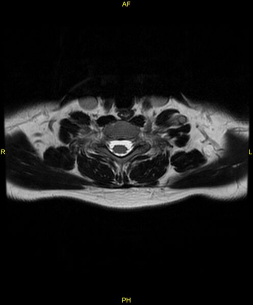 File:C5 nerve sheath tumor (Radiopaedia 85777-101596 Axial T2 62).jpg