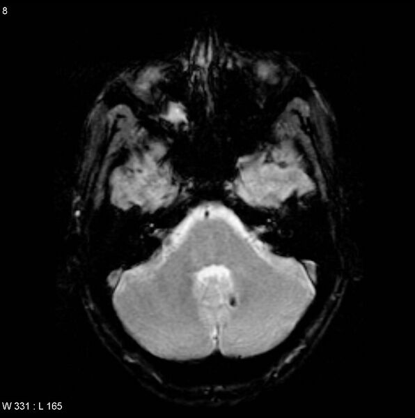 File:CMV ventriculitis and encephalitis (Radiopaedia 5416-7166 Axial Gradient Echo 1).jpg