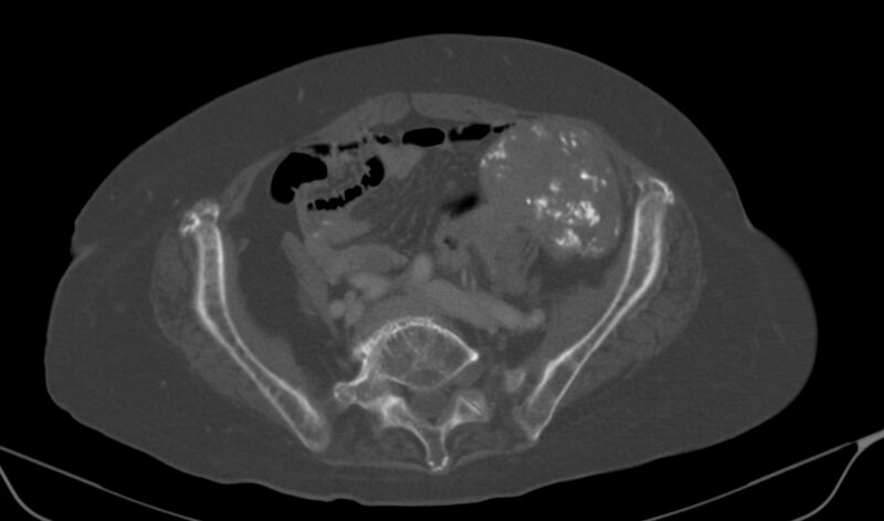 File:Calcified fibroids (Radiopaedia 20306-20228 Axial bone window 10).jpg