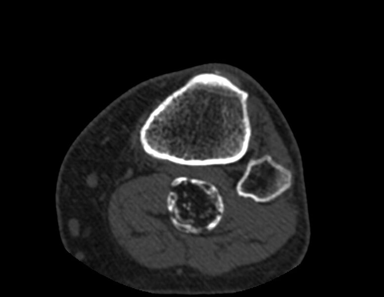 File:Calcified hematoma - popliteal fossa (Radiopaedia 63938-72763 Axial bone window 79).jpg