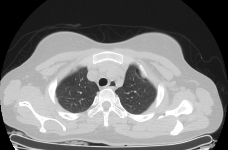 File:Cannonball metastases - uterine choriocarcinoma (Radiopaedia 70137-80173 Axial lung window 5).jpg