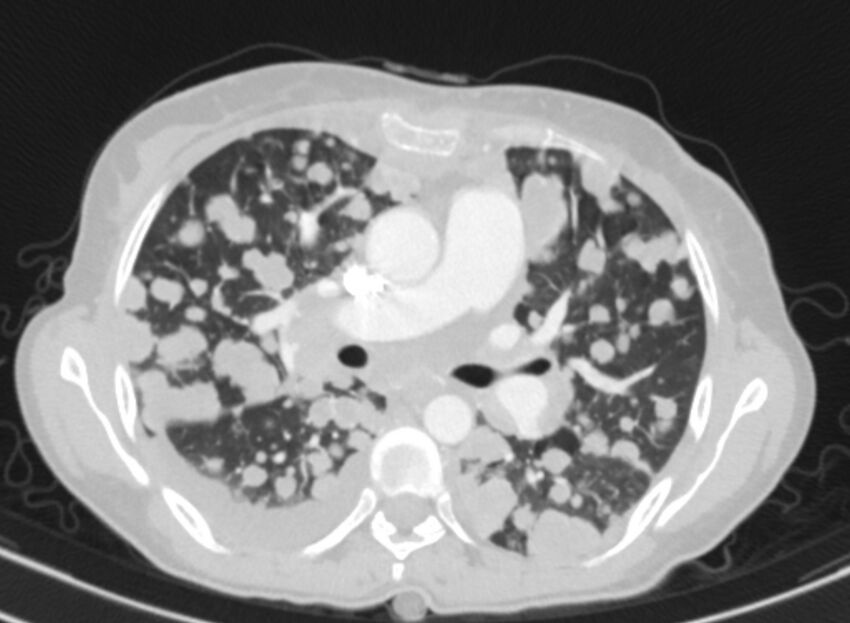 Cannonball metastases from breast cancer (Radiopaedia 91024-108569 Axial lung window 42).jpg