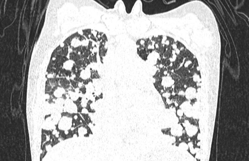 Cannonball metastases from breast cancer (Radiopaedia 91024-108569 Coronal lung window 59).jpg