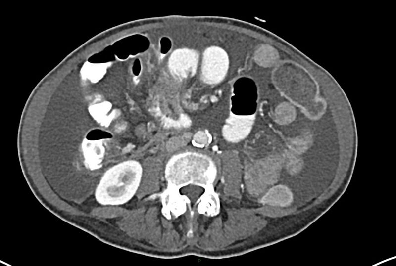 File:Carcinoid mesenteric tumor complicated by chylous ascites (Radiopaedia 76312-87953 A 41).jpg