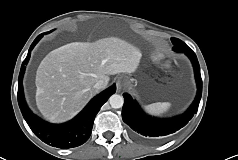 File:Carcinoid mesenteric tumor complicated by chylous ascites (Radiopaedia 76312-87953 A 8).jpg