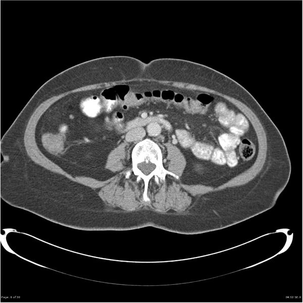 File:Carcinoid tumor of the ileum with metastasis to orbit (Radiopaedia 28165-28425 A 6).jpg