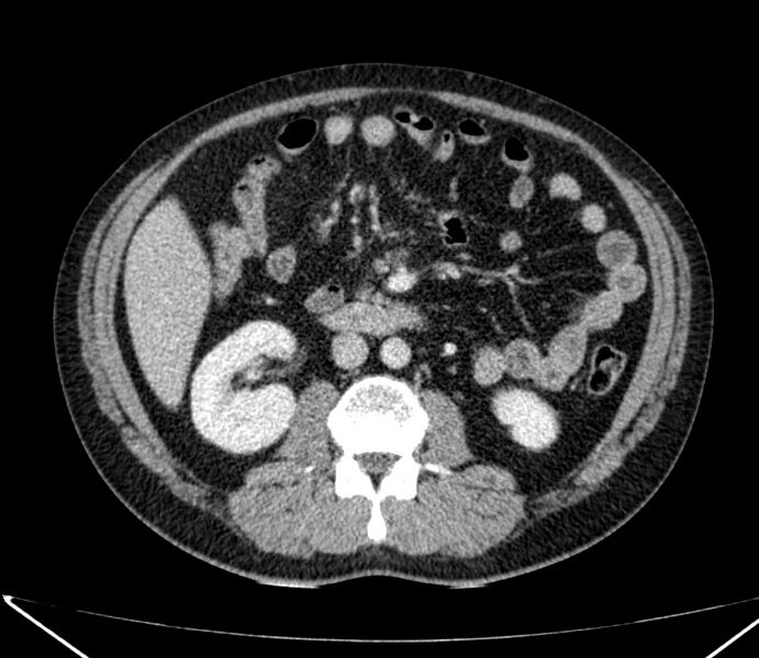 File:Carcinoid tumor with hepatic metastases (Radiopaedia 22651-22670 C 49).jpg