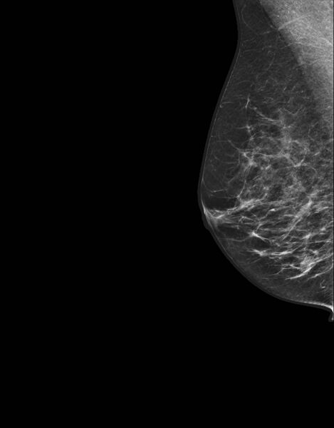 File:Carcinoma right breast (Radiopaedia 37991-39939 MLO 1).jpg