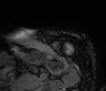 Cardiac amyloidosis (Radiopaedia 39736-42124 F 20).jpg