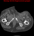 Cardiac perforation following transcatheter aortic valve implantation (Radiopaedia 23714-23863 B 17).png