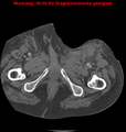 Cardiac perforation following transcatheter aortic valve implantation (Radiopaedia 23714-23863 B 18).png