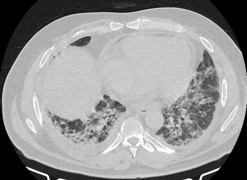 File:Cardiogenic pulmonary edema (Radiopaedia 68180-77678 Axial lung window 67).jpg