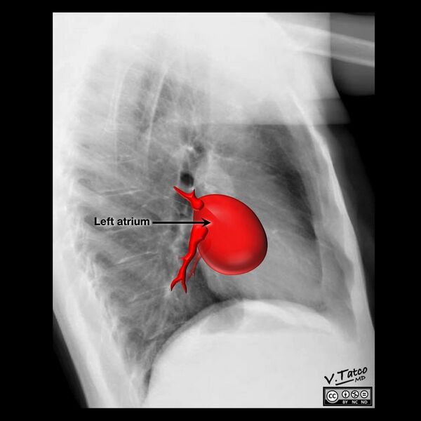 File:Cardiomediastinal anatomy on chest radiography (annotated images) (Radiopaedia 46331-50748 Q 5).jpeg