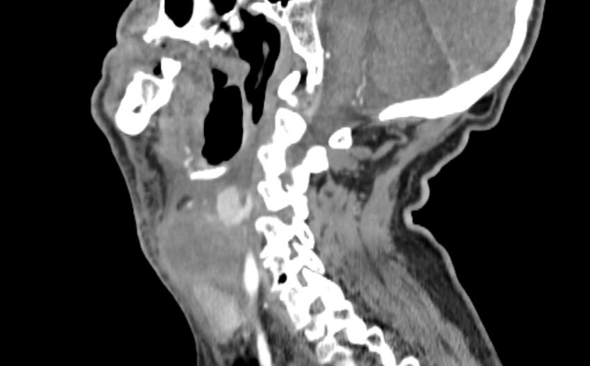 Carotid artery pseudoaneurysm (Radiopaedia 84030-99259 E 16).jpg