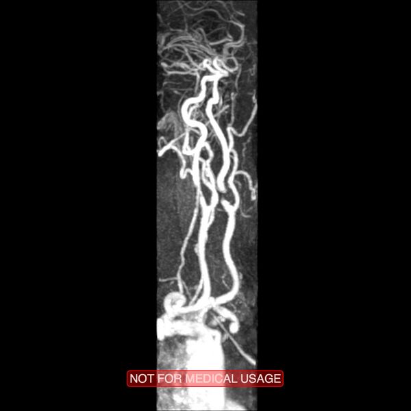 File:Carotid artery stenosis (Radiopaedia 28786-29087 3D MRA 2).jpg