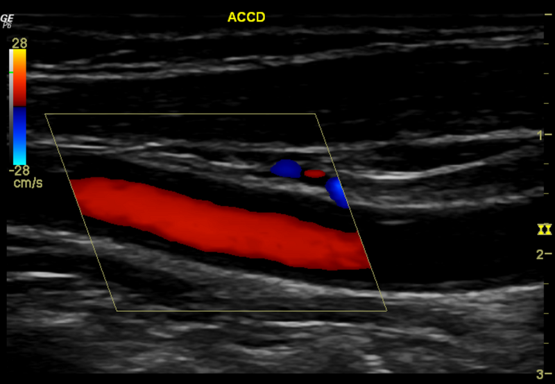 File:Carotid artery stenosis (Radiopaedia 28786-29088 B 1).png