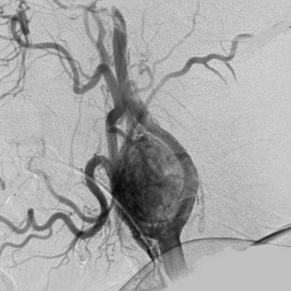 File:Carotid body tumor on angiography (Radiopaedia 4651-6729 A 4).jpg