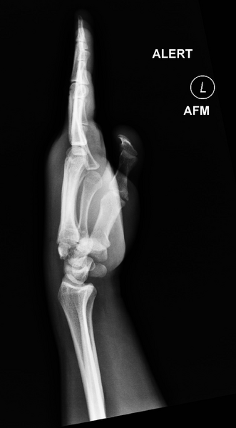 File:Carpal fractures - smart watch impaction (Radiopaedia 55844-62429 Lateral 1).png