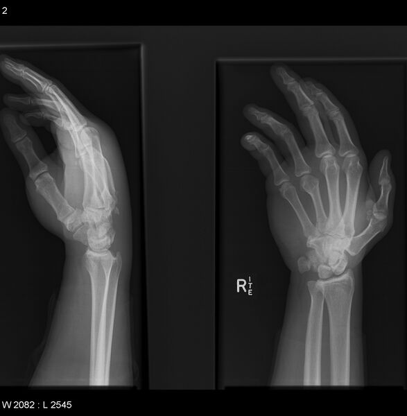File:Carpometacarpal fracture dislocation (Radiopaedia 12281-12576 B 1).jpg