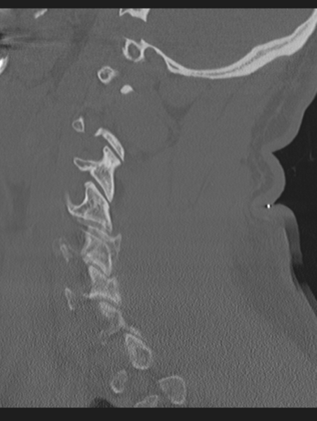 File:Cavernoma of cervical cord (Radiopaedia 50838-56346 Sagittal bone window 58).png