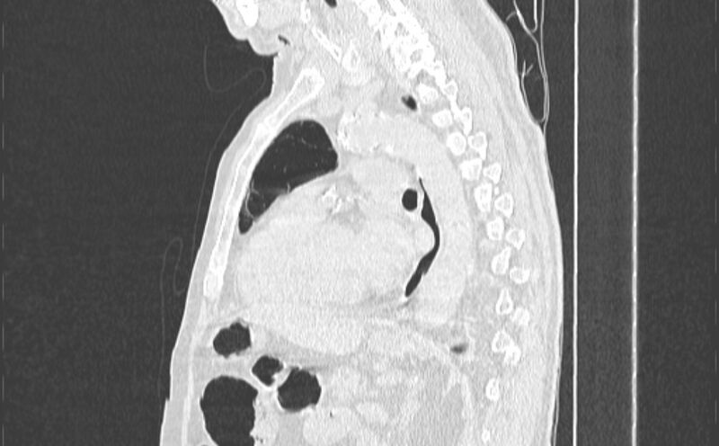 File:Cavitating bronchogenic carcinoma (Radiopaedia 44489-48162 Sagittal lung window 37).jpg