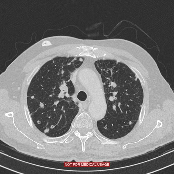 File:Cavitating pulmonary metastases (Radiopaedia 24920-25184 Axial lung window 6).jpg