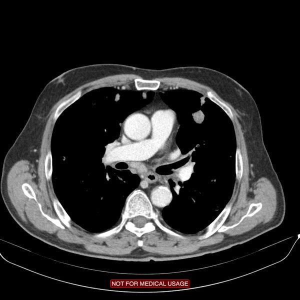 File:Cavitating pulmonary metastases (Radiopaedia 24920-25184 B 12).jpg