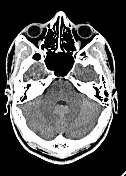 File:Cavum septum pellucidum and cavum vergae (Radiopaedia 77797-90060 Axial Brain Window 28).jpg