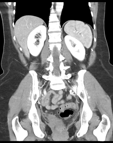 File:Cecum hernia through the foramen of Winslow (Radiopaedia 46634-51112 B 32).png