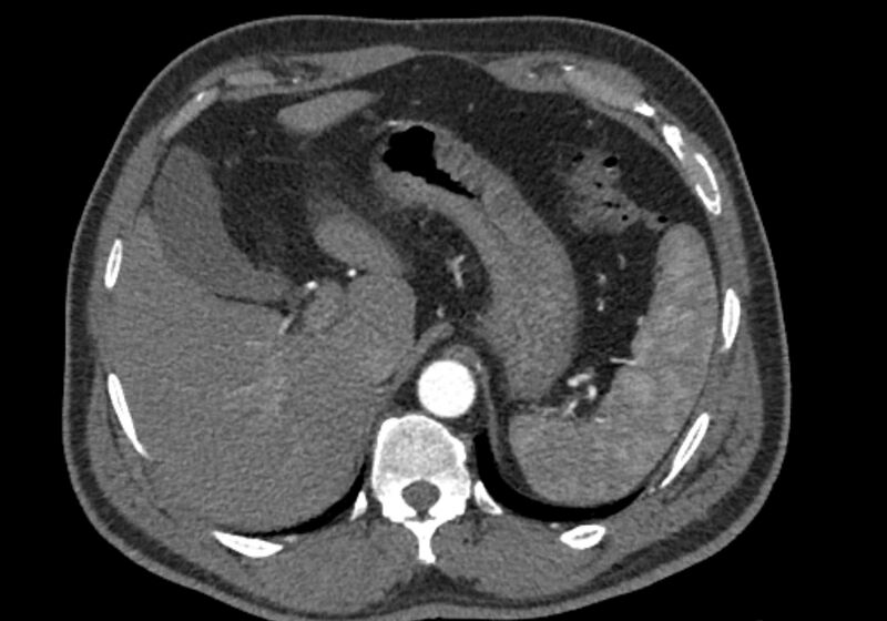 File:Celiac artery dissection (Radiopaedia 52194-58080 A 15).jpg