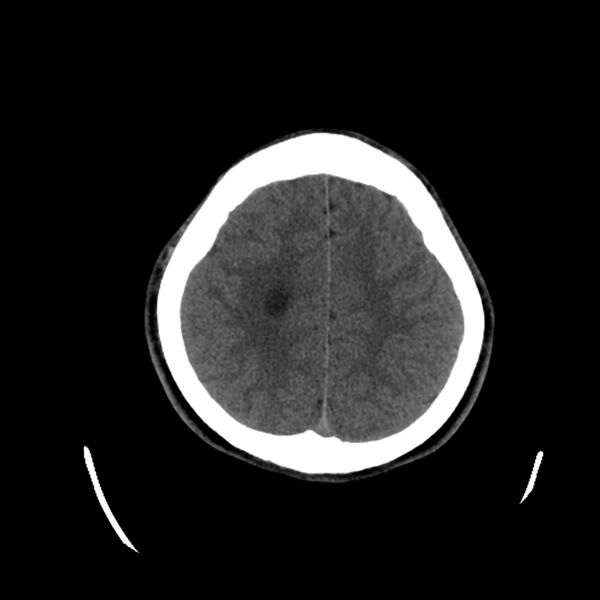 File:Central neurocytoma (Radiopaedia 79320-92379 Axial non-contrast 35).jpg