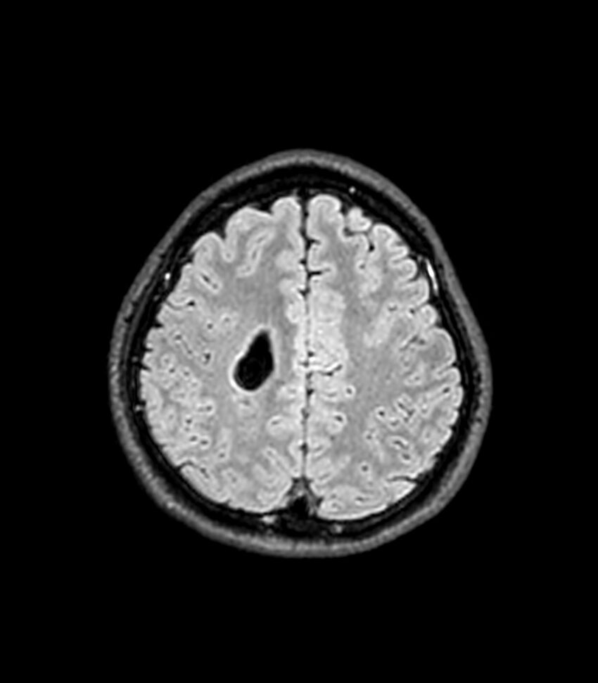 Central neurocytoma (Radiopaedia 79320-92380 Axial FLAIR 87).jpg