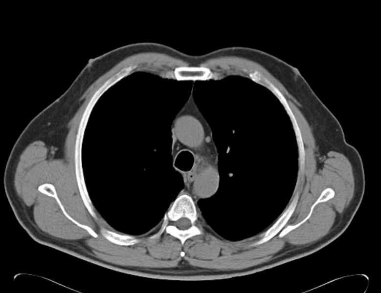 File:Centrilobular pulmonary emphysema (Radiopaedia 26808-26971 Axial non-contrast 14).jpg