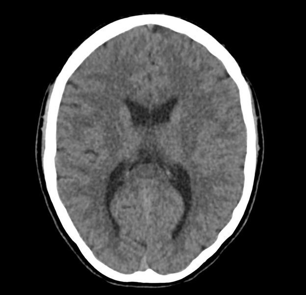 File:Cerebellar agenesis (Radiopaedia 30203-30817 Axial non-contrast 27).jpg