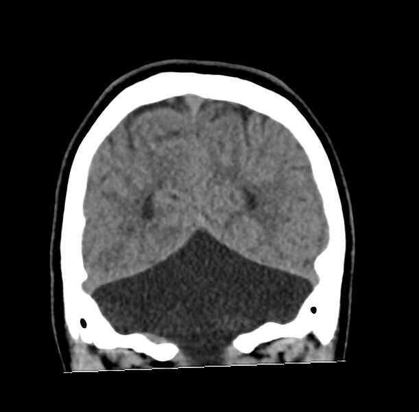 File:Cerebellar agenesis (Radiopaedia 30203-30817 Coronal non-contrast 39).jpg