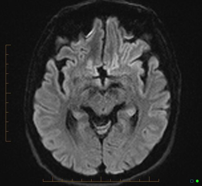 File:Cerebellar gangliocytoma (Radiopaedia 65377-74422 Axial DWI 17).jpg