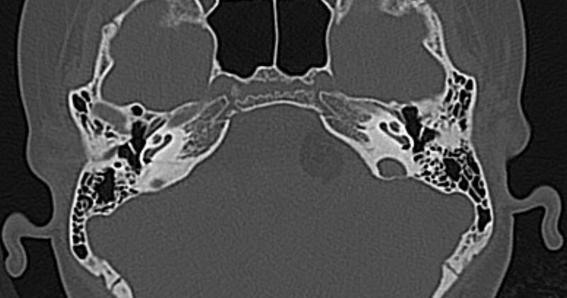 File:Cerebellopontine angle lipoma (Radiopaedia 57303-64242 Axial bone window 24).jpg